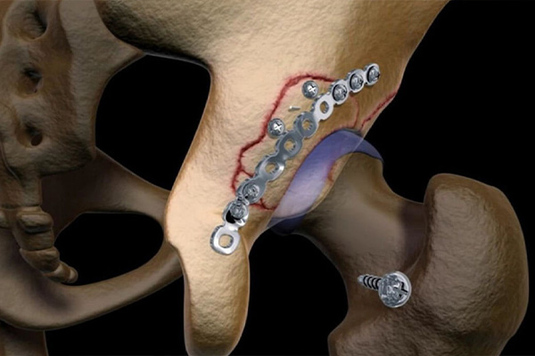 Bone Fixation Surgery