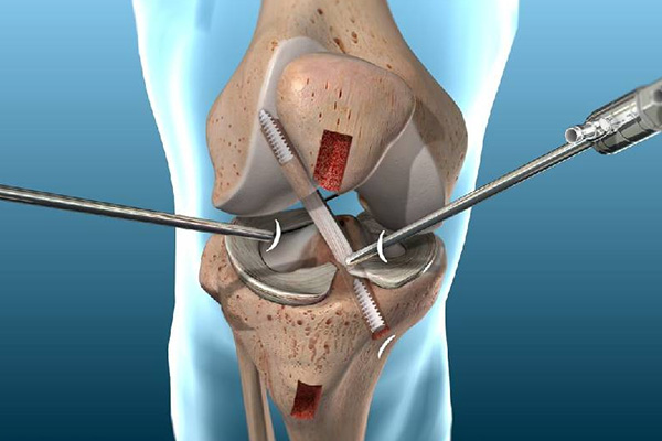 ACL/PCL Reconstruction