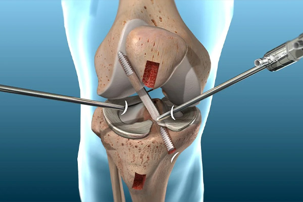 Ligament Surgery