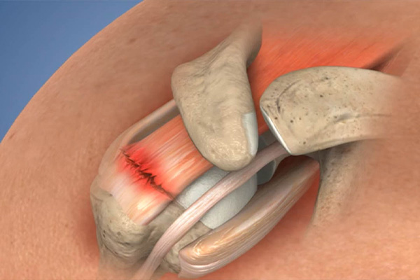 Rotator Cuff Repair