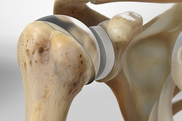Shoulder Replacement Surgery